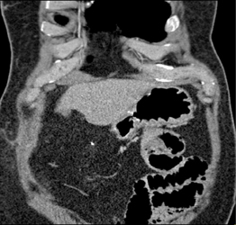 Gastric Cancer - CTisus CT Scan