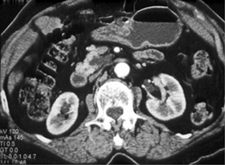 Gastric Cancer - CTisus CT Scan