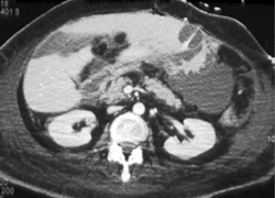 G-tube With Leak - CTisus CT Scan