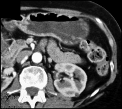 Gastritis - CTisus CT Scan