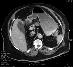 Gastric Antral Thickening With Perforation - CTisus CT Scan