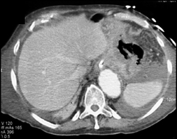 Necrotizing Gastric Infection - CTisus CT Scan