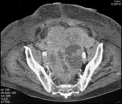 Carcinomatosis - CTisus CT Scan