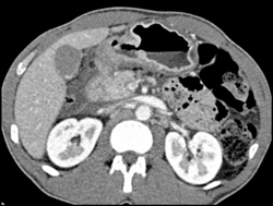 Antral Cancer With Adenopathy - CTisus CT Scan