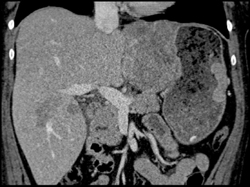 4 Cm Neuroendocrine Tumor of the Stomach - CTisus CT Scan