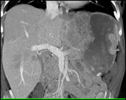 4 Cm Neuroendocrine Tumor of the Stomach With Liver Metastases - CTisus CT Scan