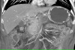 Gastric Varices - CTisus CT Scan