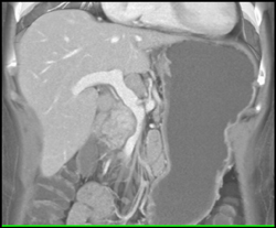 Gastric Varices - CTisus CT Scan