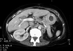 Linitis Plastica Secondary to Breast Cancer - CTisus CT Scan