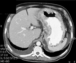 Kaposi Sarcoma - CTisus CT Scan