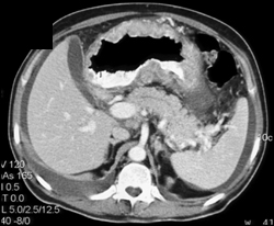 Kaposis Sarcoma - CTisus CT Scan