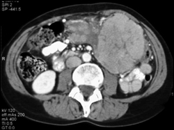 GIST Tumor - CTisus CT Scan