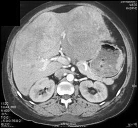 Neuroendocrine Tumor Primary to Stomach - CTisus CT Scan