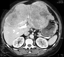 stomach ctisus neuroendocrine