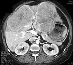 stomach ctisus neuroendocrine