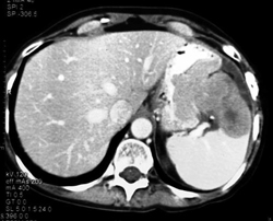 Gastric Plasmocytoma - CTisus CT Scan