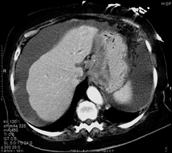 Gastric Cancer and Carcinomatosis - CTisus CT Scan