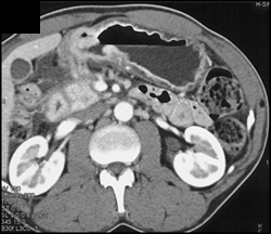 Gastric Cancer - CTisus CT Scan