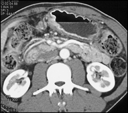 Gastric Cancer - CTisus CT Scan