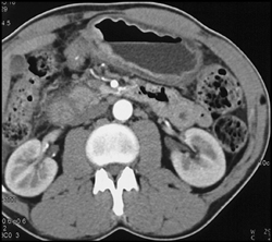 Gastric Cancer - CTisus CT Scan