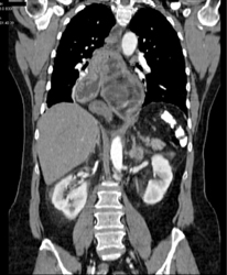 Huge Obstruction Due to Hiatal Hernia - CTisus CT Scan