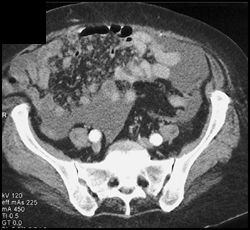 Carcinomatosis - CTisus CT Scan