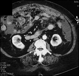 Carcinomatosis - CTisus CT Scan