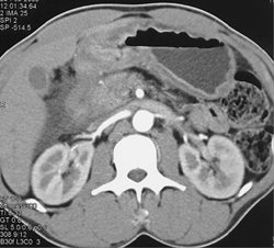 Antral Cancer - CTisus CT Scan