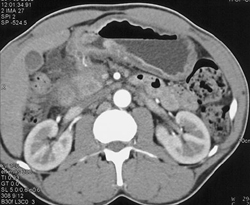 Antral Cancer - CTisus CT Scan