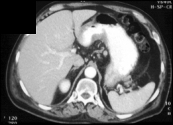 Gastric Cancer - CTisus CT Scan