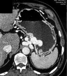 Gastric Varices - CTisus CT Scan