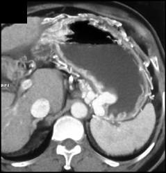 Gastric Varices - CTisus CT Scan