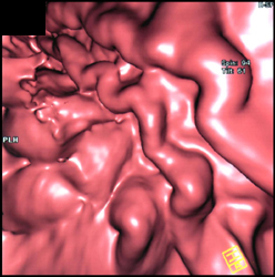 Gastric Varices - CTisus CT Scan