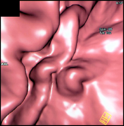 Gastric Varices - CTisus CT Scan