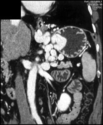 Gastric Varices - CTisus CT Scan