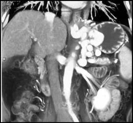 Gastric Varices - CTisus CT Scan