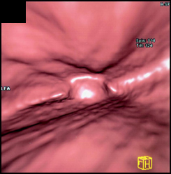 2 Cm Gist - CTisus CT Scan