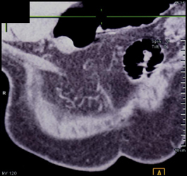 GIST Tumor in the Antrum - CTisus CT Scan