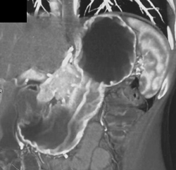 Normal Gastric Folds - CTisus CT Scan