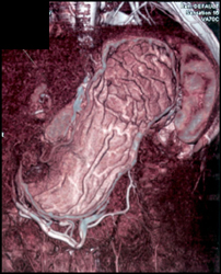 Normal Gastric Folds - CTisus CT Scan