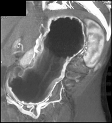 Normal Gastric Folds - CTisus CT Scan