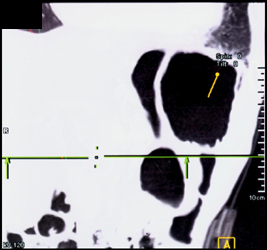 Stomach With Fluid - CTisus CT Scan