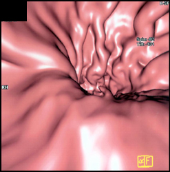 Prominent Gastric Folds Due to Carcinoma - CTisus CT Scan