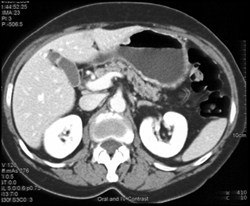 Gastric Adenocarcinoma - CTisus CT Scan