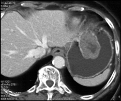 GIST Tumor - CTisus CT Scan