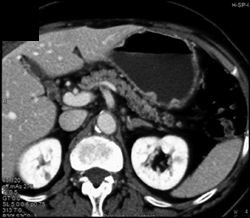 Multiple Gastric Polyps - CTisus CT Scan