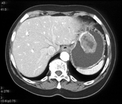 GIST Tumor - CTisus CT Scan