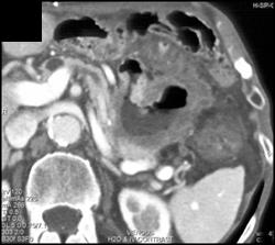 Gastric Adenocarcinoma - CTisus CT Scan