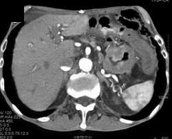 Gastric Adenocarcinoma - CTisus CT Scan