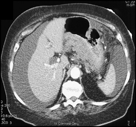 Gastric Carcinoma With Carcinomatosis - CTisus CT Scan